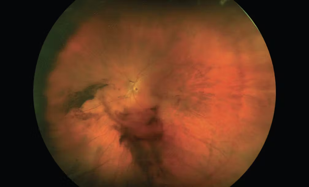 Posterior Vitreous Detachment Complicated by Vitreous Haemorrhage