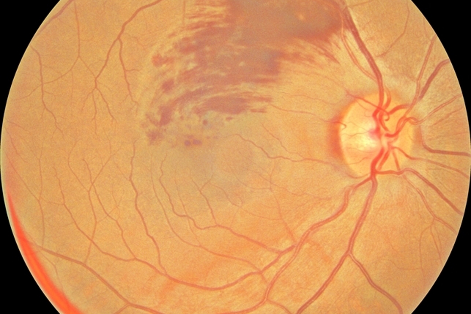 Branch Retinal Vein Occlusion (BRVO): Symptoms, Diagnosis & Treatment in Birmingham