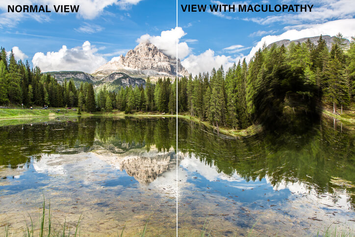 Simulated view of landscape with normal vision versus macular degeneration distortion