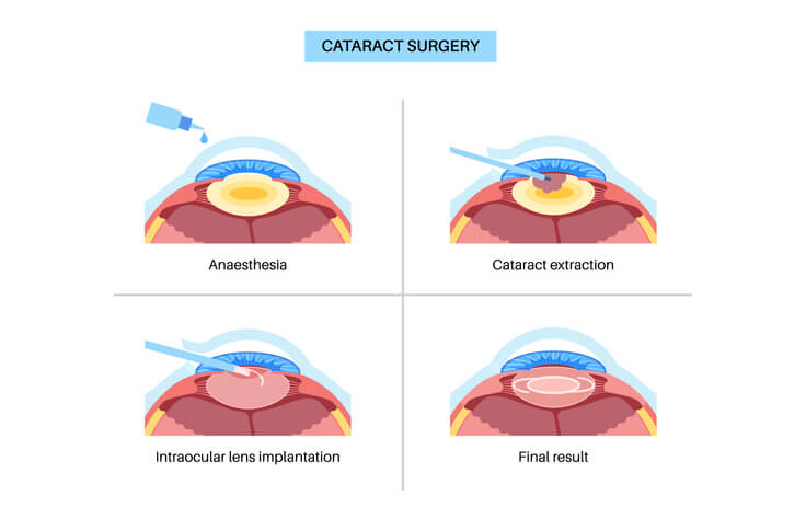 Diagram of cataract surgery showing the intraocular lens (IOL) being implanted and positioned in the eye.