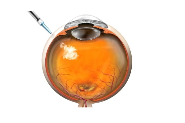 Diagram showing intravitreal injection for treating wet AMD with anti-VEGF medication