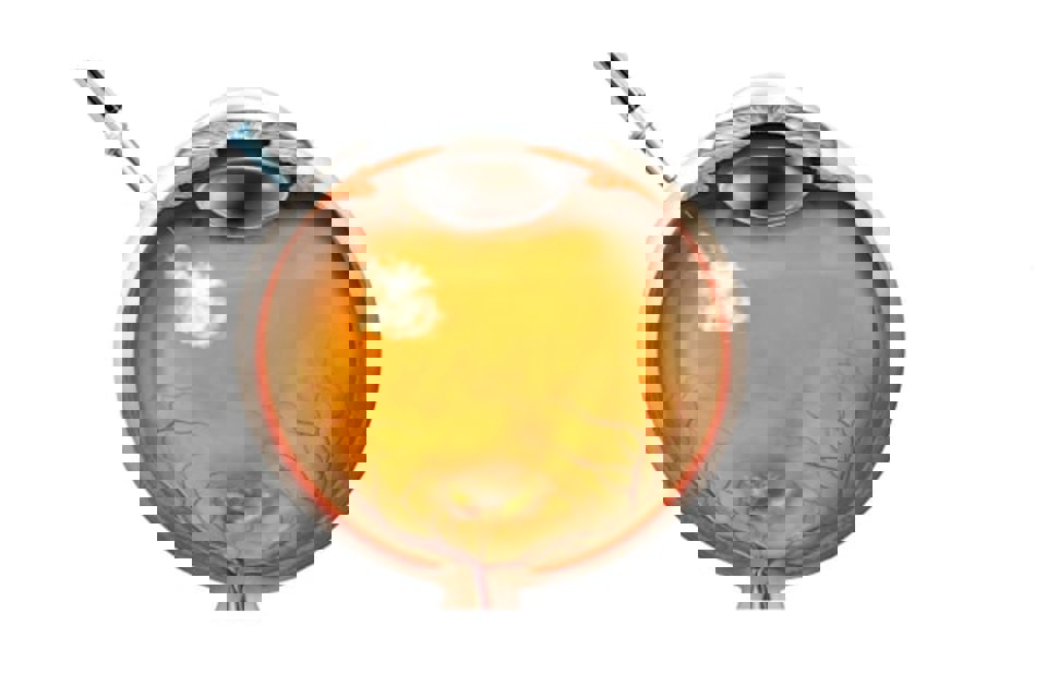 How Much Does Private Retinal Vein Occlusion (RVO) Treatment Cost in Birmingham?