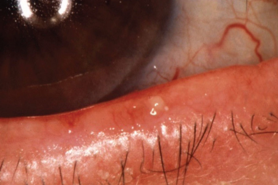 Blepharitis Treatment: Why Your Eyelids Are Red & Crusty (And How to Fix It)