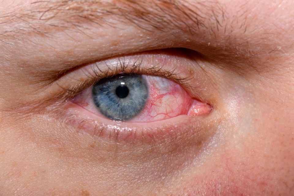 Dry Eye Symptoms: Why Your Eyes Water But Still Feel Dry