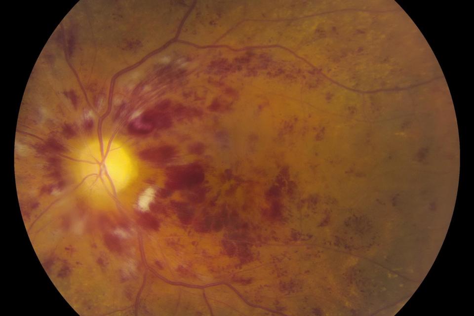 Central Retinal Vein Occlusion (CRVO): Symptoms, Diagnosis & Treatment in Birmingham