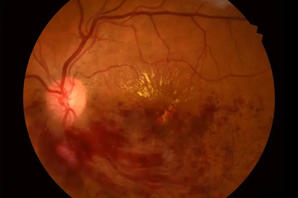 Retinal Disease Management