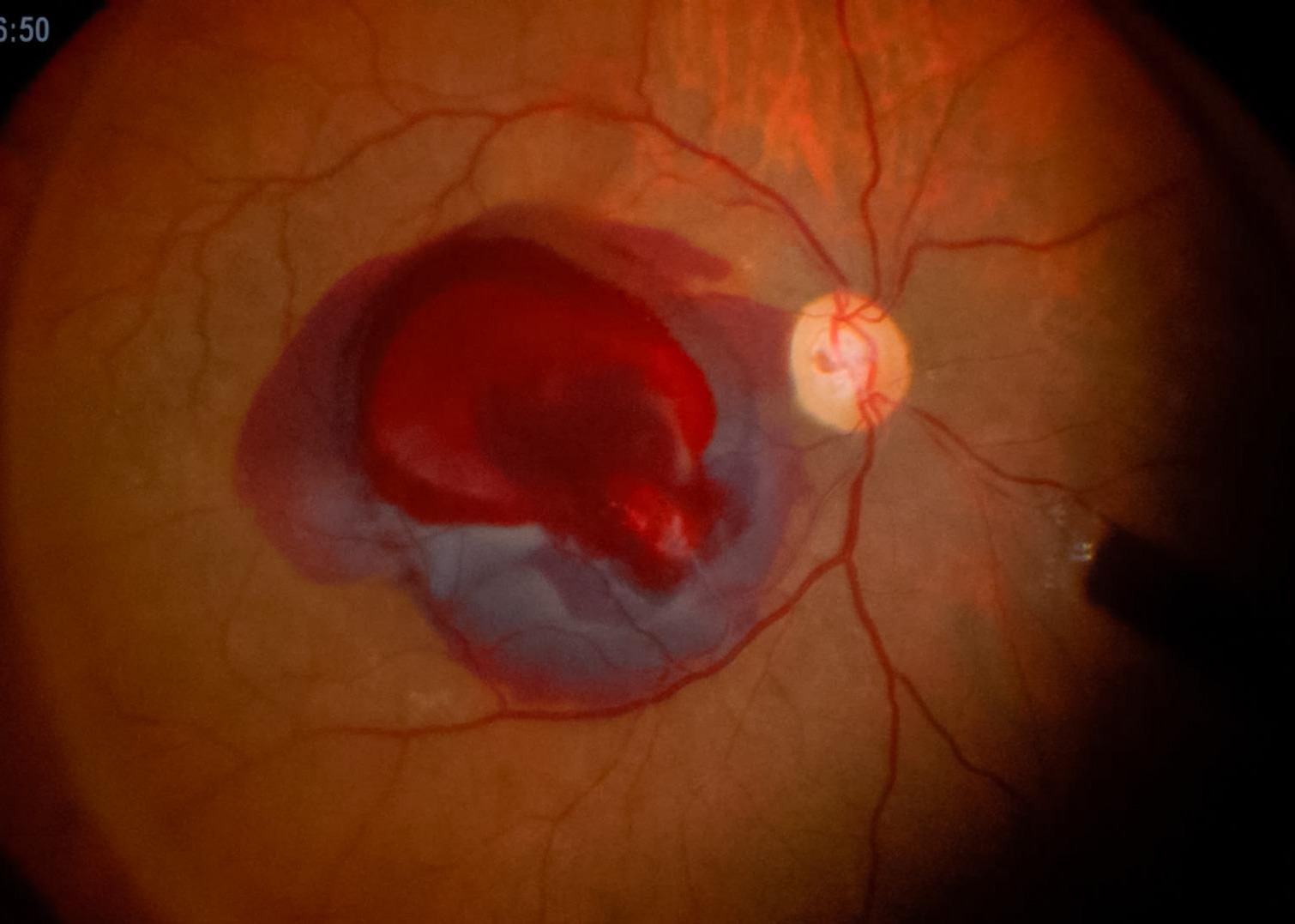 Retinal Macroaneurysm Causing Multilayer Retinal Bleeding at the back of the Eye and Vitreous Haemorrhage