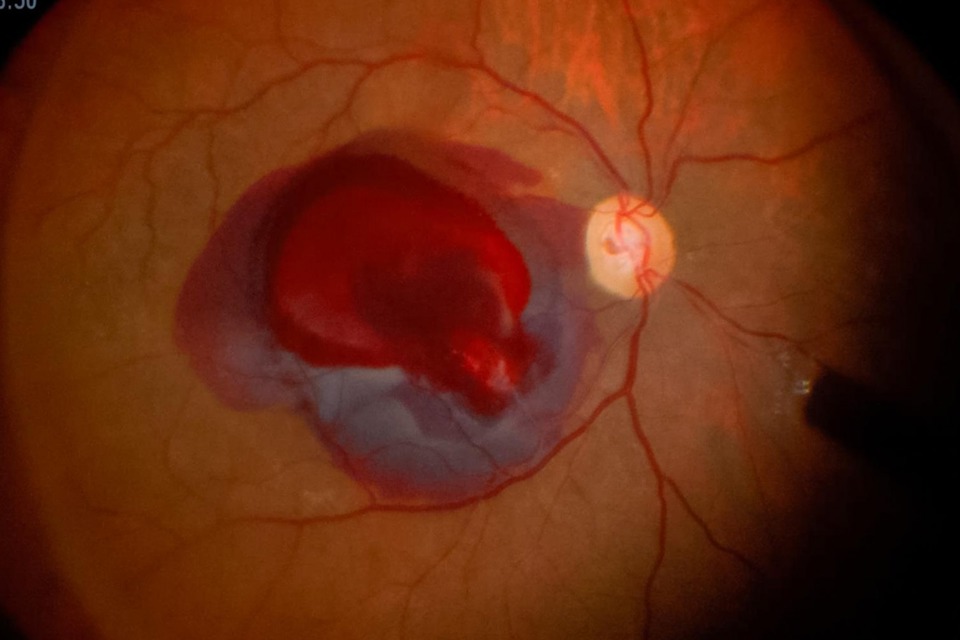 Vitreous Haemorrhage: Symptoms, Causes, and Prognosis