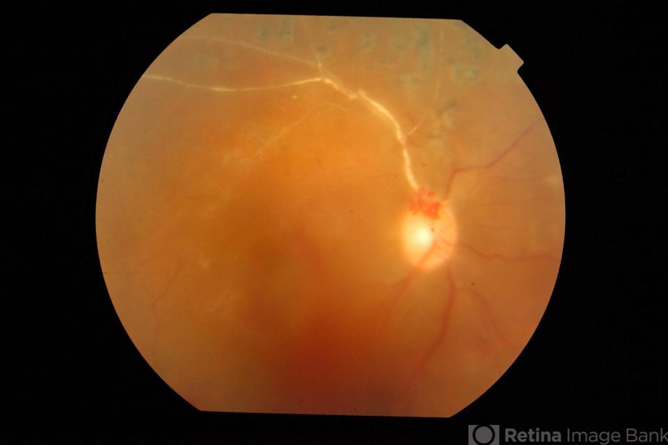 Retinal Vein Occlusion Treatment in Birmingham